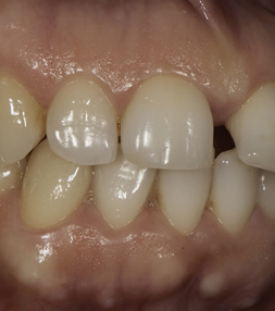 Teeth before dental treatment