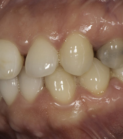 Teeth before a dental treatment