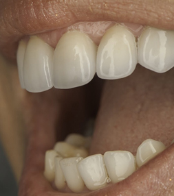 Teeth after a dental treatment