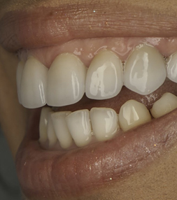 Patient's smile after a dental treatment
