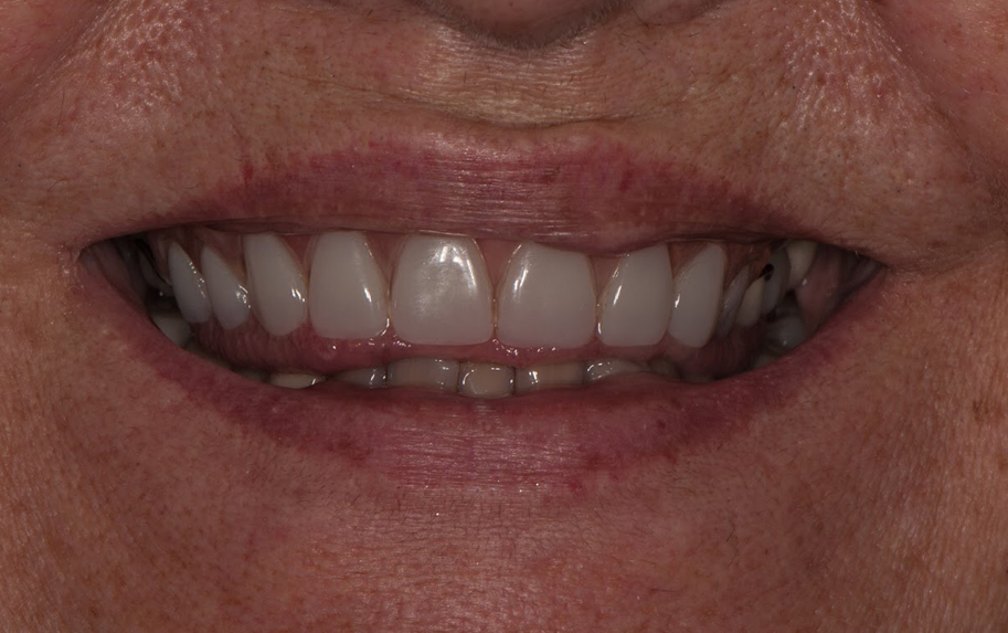 Teeth before a dental procedure