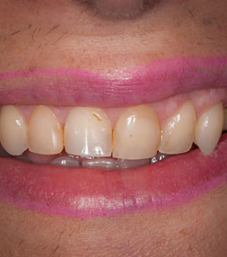 Patient's teeth before dental treatment