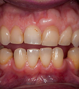 Patient's teeth before a dental treatment
