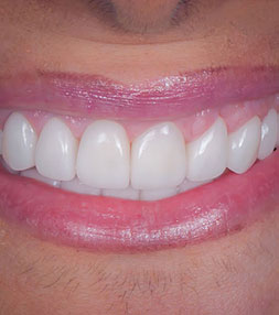 Patient's bright smile after a dental procedure