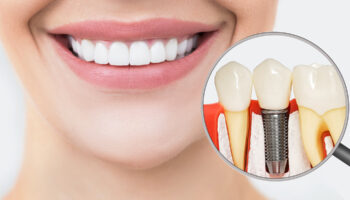 Reasons to Gift Yourself Dental Implants This Year