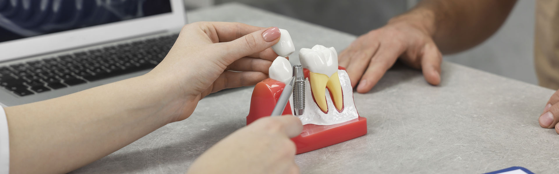 Why Dental Implants Are the Long-Term Solution for Tooth Loss