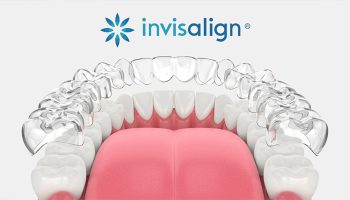 Types of Dental Problems Invisalign Can Correct