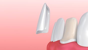 How Porcelain Veneers Can Fix Chips, Gaps, and Stains
