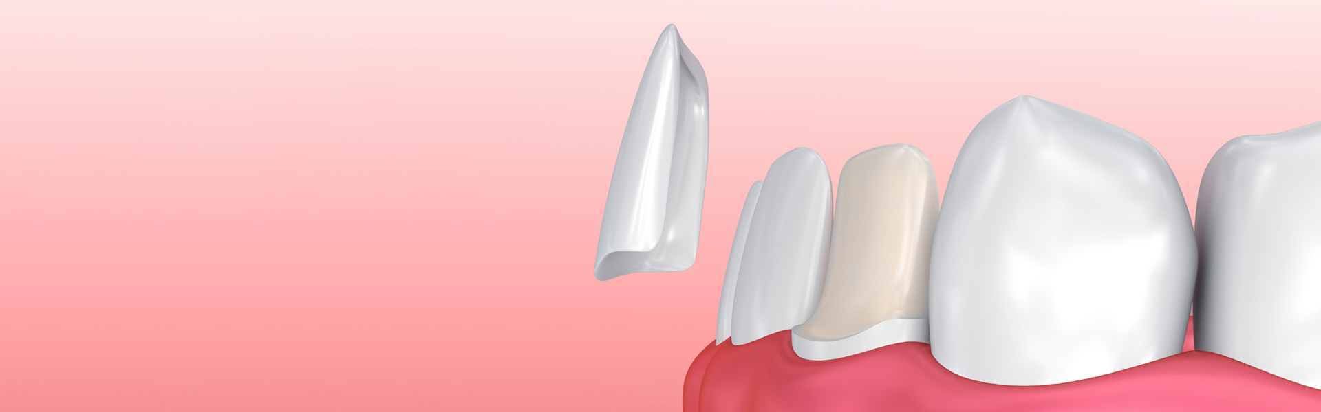 How Porcelain Veneers Can Fix Chips, Gaps, and Stains